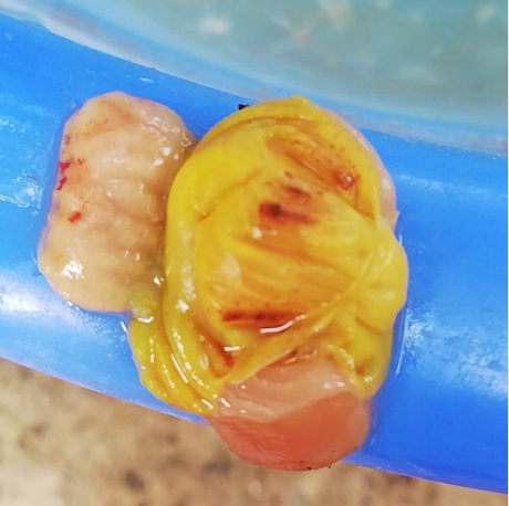 一例肉鸡病毒性腺肌胃炎病例诊治